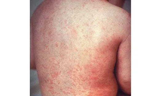 Tragic Measles Outbreak Claims Five Young Lives in Uganda