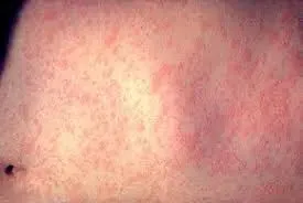 Measles Epidemic Escalates in the United States