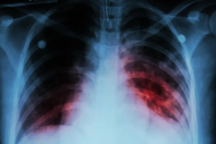 21.69 Lakh TB Cases Reported from January to October: Government Update
