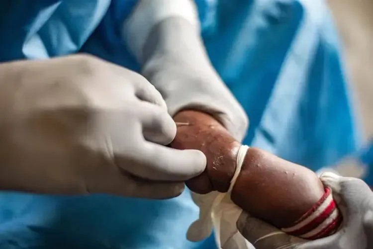 Mpox Fatalities in Africa Reach 260 Amidst Humanitarian Crisis in Congo