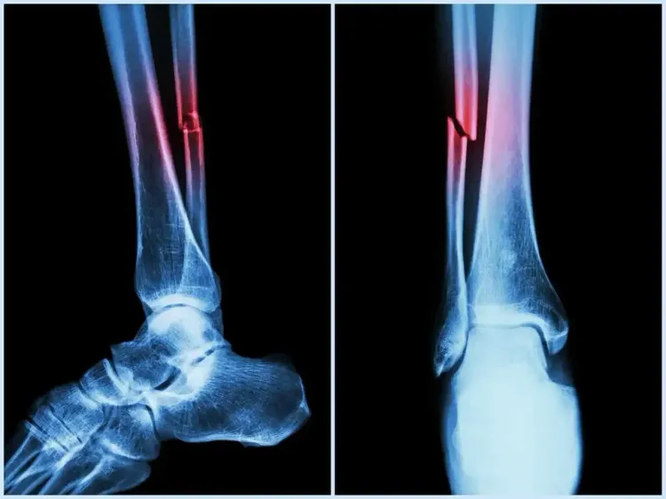 How Can NIT Rourkela's Study Enhance Bone Regeneration Technology?