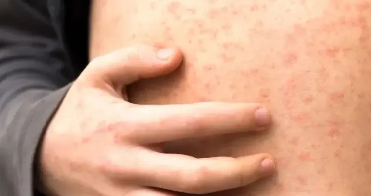 Could the Texas Outbreak Undermine the US's Measles Elimination Status?