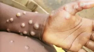 Karnataka Government Reassures Public Regarding Monkeypox Case