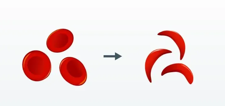 How is the Sickle Cell Elimination Mission Ensuring Regular Treatment at Primary Care Centres?