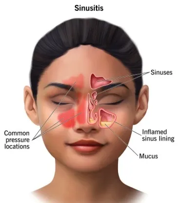 Is Surgery More Effective in Treating Chronic Sinusitis Than Antibiotics?