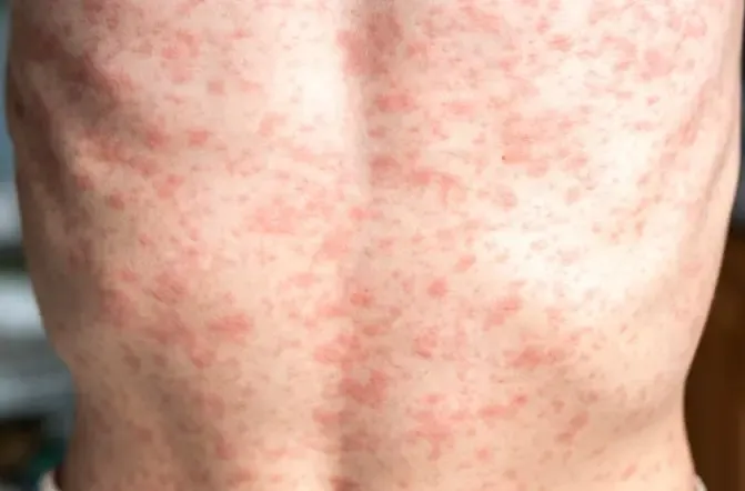 Third Measles Death Confirmed in the US; Kennedy Visits West Texas Amid Increasing Cases