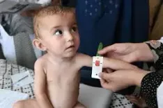 Afghan children with heart disease receive free treatment
