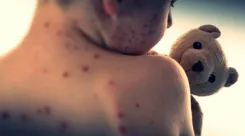 Did a Child Die from Measles in Ulan Bator?