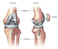 Could Diabetes Elevate Infection and Blood Clot Risks After Knee Replacement Surgery?