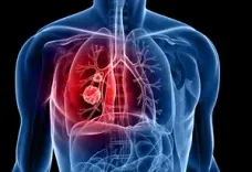 Doctors raise concern over rising lung cancers among non-smokers in India