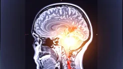 Could Oral and Gut Bacteria Exacerbate Parkinson's Disease?