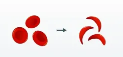 How is the Sickle Cell Elimination Mission Ensuring Regular Treatment at Primary Care Centres?