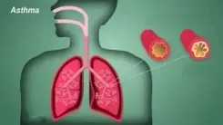 Targeted therapies, diagnostics remain concern for severe asthma: Report