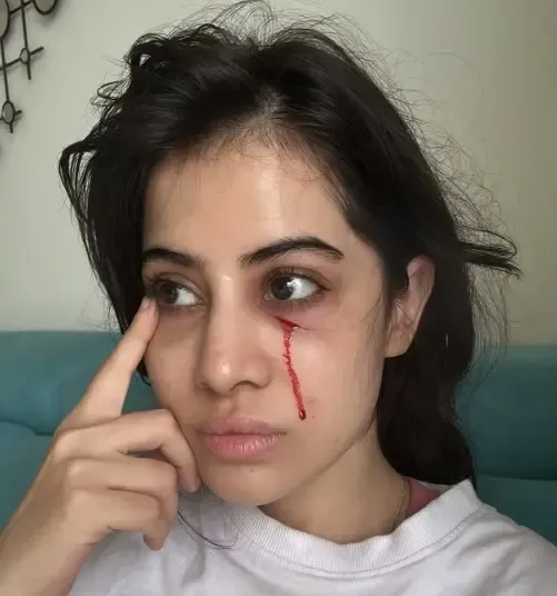 क्या उर्फी जावेद को लगी चोट? चेहरे से बहता दिखा खून