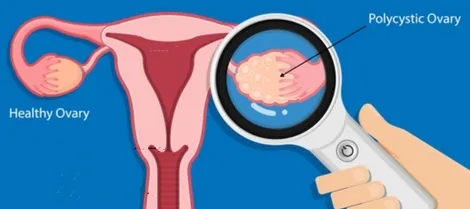 US Scientists Unravel Ovarian Cancer Origins