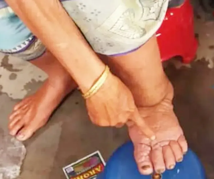 क्या योगी सरकार रात्रि चौपाल, नुक्कड़ नाटक और एमडीए यात्रा से फाइलेरिया को मात दे रही है?